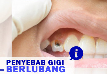 Mengatasi Gigi Berlubang